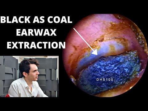 Видео: Черная как уголь ушная сера (извлеченная с помощью масла и отсасывания)