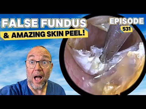 Видео: Ложное глазное дно и потрясающий пилинг кожи! Эпизод 531 (ТАК УДОВЛЕТВОРИТЕЛЬНО!)