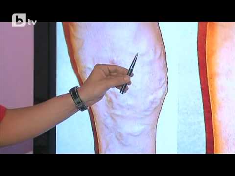 Видео: Безкръвно лечение на разширени вени - пластична хирургия на тяло