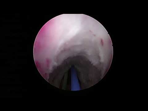 Видео: Urethral Stricture Treatment with the Holmium Laser/Лазерная внутренняя оптическая уретротомия/ВОУТ