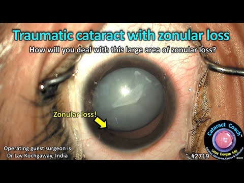 Видео: CataractCoach™ 2719: травматическая катаракта с потерей зонулярной ткани — это сложно!