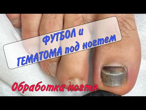 Видео: 🍷ГЕМАТОМА под ногтем / синяк под ногтем / ушиб пальца