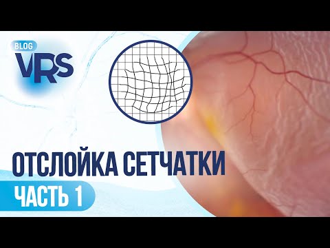 Видео: Отслойка сетчатки / часть 1