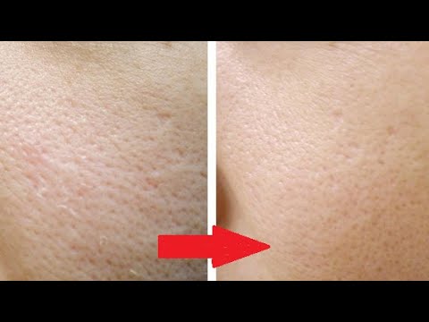 Видео: РАСШИРЕННЫЕ ПОРЫ - как избавиться? Чем сузить поры на лице? Что помогает от расширенных пор?