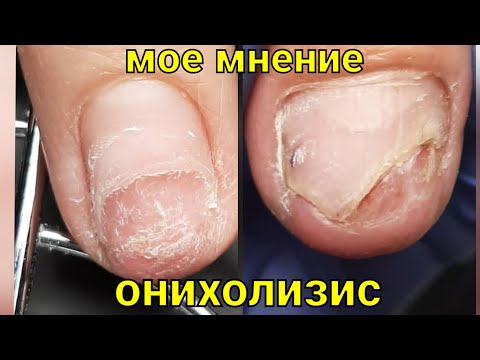 Видео: Моё мнение #7. Онихолизис.