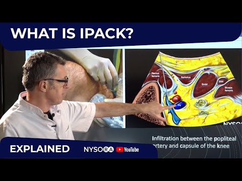 Видео: Что такое Ipack? — Экспресс-курс регионарной анестезии с доктором Хаджичем