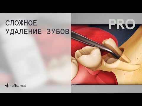 Видео: 💁‍♂️ Что такое сложное удаление зубов?