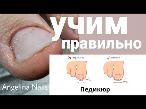 Видео: ВРАСТАЕТ НОГОТЬ / учим правильно подстригать / протезирование акрилом / педикюр подростку