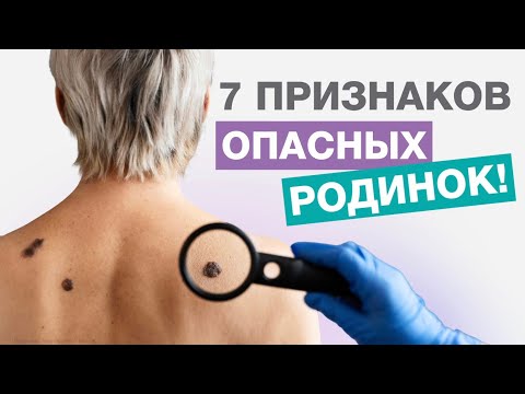 Видео: 7 признаков опасных родинок
