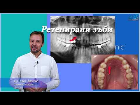 Видео: #РЕТЕНИРАНИ ЗЪБИ. #ортодонтия #ортодонт #брекети