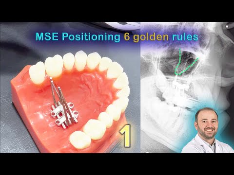 Видео: 6 основных золотых правил размещения MSE. Как разместить MARPE для достижения наилучших результатов!