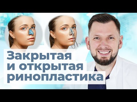 Видео: Открытая или закрытая ринопластика? Какой метод пластики носа лучше?