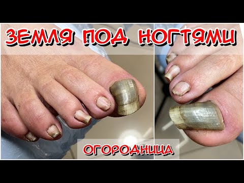Видео: Земля под ногтями / Толстый ноготь / Онихогрифоз / Есть ли тут грибок? Что с ногтем?