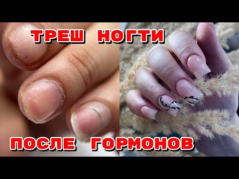 Видео: ТРЕШ НОГТИ ПОСЛЕ ГОРМОНОВ 😨 Наращивание за полтора часа 💅 Маникюр