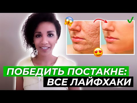 Видео: Убрать пятна от прыщей и рубцы постакне: реальная стоимость лечения и самые эффективные способы