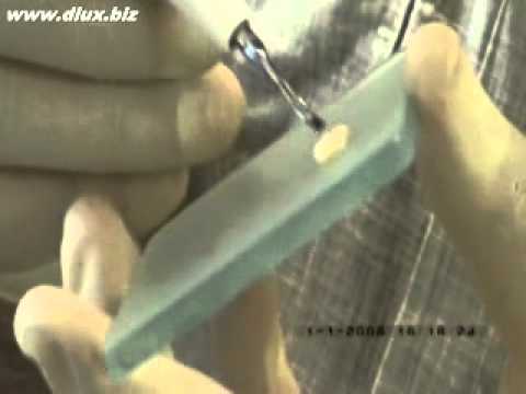 Видео: Ультразвуковой скалер в стоматологии.Часть №5