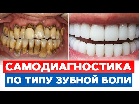 Видео: Симптомы проблем с зубами. Как понять, что пора к стоматологу? / Кровоточат десны, ноющая боль