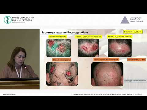 Видео: Современные подходы в лечении базальноклеточного рака кожи