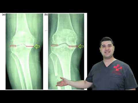 Видео: Нов метод лекува износени колене!