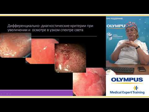 Видео: Комплексная эндоскопическая диагностика Неходжкинских лимфом желудка. Малихова О. А.