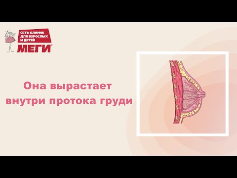 Видео: Обязательно удалите такую папиллому!