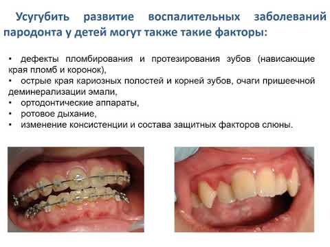 Видео: Особенности проведения профессиональной гигиены  у детей