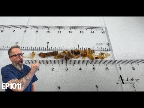 Видео: Боль в ушах облегчена удалением ушной серы - EP1011