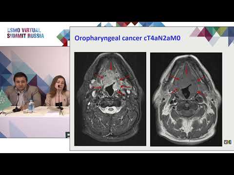 Видео: Плоскоклеточный рак опухолей головы и шеи. Клинический случай 3