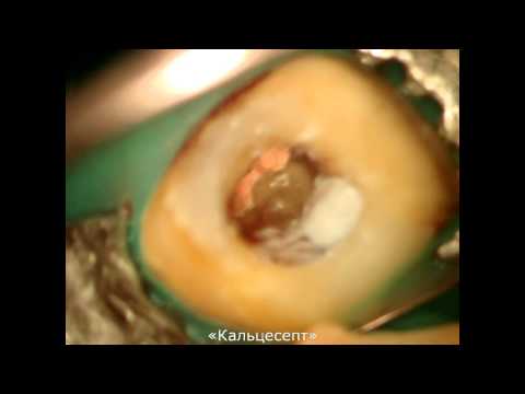 Видео: Применение материала Триоксидент