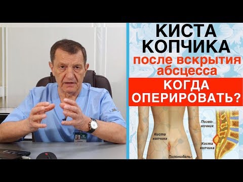 Видео: КИСТА КОПЧИКА - Когда нужно ОПЕРИРОВАТЬ КИСТУ КОПЧИКА после вскрытия его абсцесса?