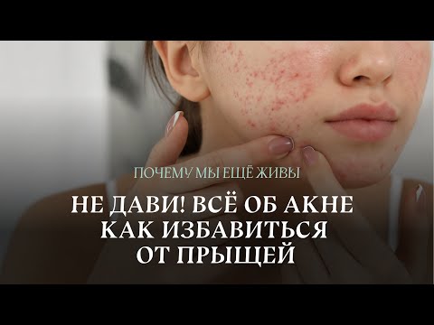 Видео: Человечество против прыщей: от припарок к ретиноидам | Почему мы еще живы