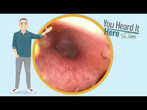 Видео: ШОКИРУЮЩЕЕ удаление ушной серы №123: доктор Гэри устраняет ОГРОМНУЮ закупорку!
