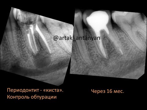 Видео: Как заживает «киста» зуба? Удаление кисты зуба. Зуб имплант. Периодонтит. Гайморит. Виниры