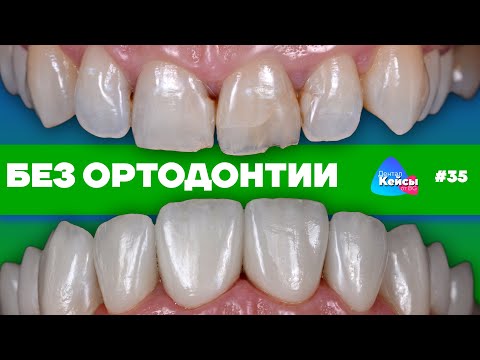 Видео: Без ортодонтии | Дентал Кейсы от BG #35