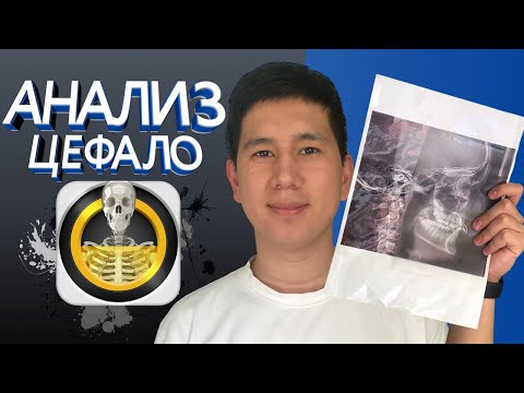 Видео: АНАЛИЗ ЦЕФАЛО | ТРГ в ОРТОДОНТИИ