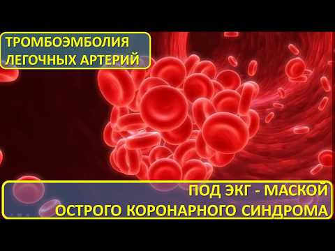 Видео: ТЭЛА под ЭКГ-маской Острого коронарного синдрома