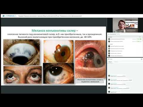 Видео: Заседание РООР Современные аспекты офтальмоонкологии 27 10 2023