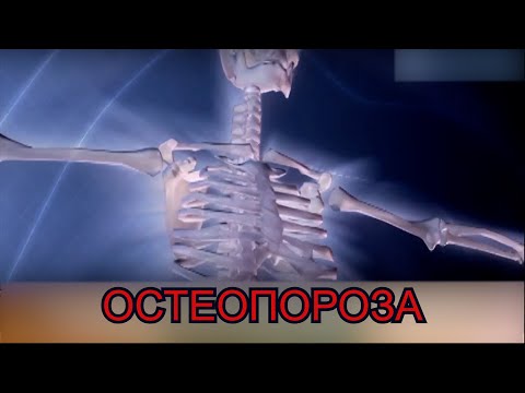 Видео: Остеопороза – симптоми, причини, рискови фактори