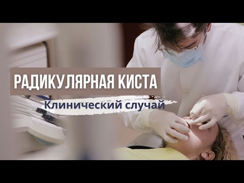 Видео: Радикулярная киста.