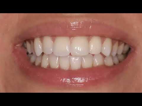 Видео: Вебинар «Внутрикоронковое отбеливание» при различных дисколоритах девитальных зубов🥲