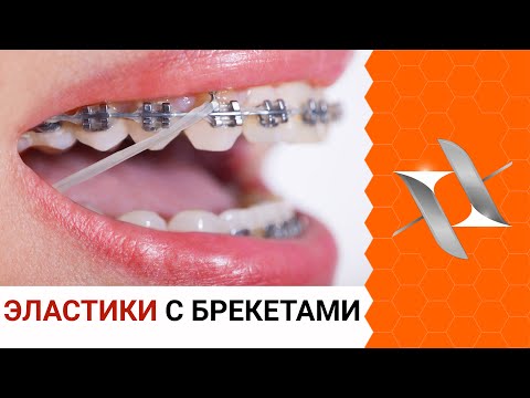 Видео: ЭЛАСТИКИ (тяги) и брекеты | Для чего? Как с ними жить?