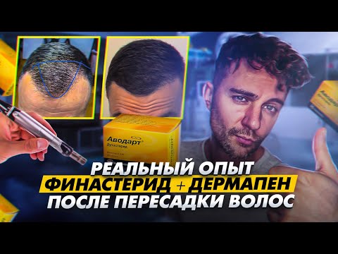 Видео: Реальный опыт с финастеридом и дермапеном: Путь к естественному и впечатляющему результату