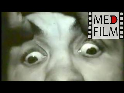 Видео: Поражение глазодвигательного и отводящего нервов © The defeat of the oculomotor and abducens