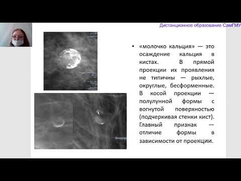 Видео: Кальцинаты в молочной железе. Лектор Колосова И.Н.