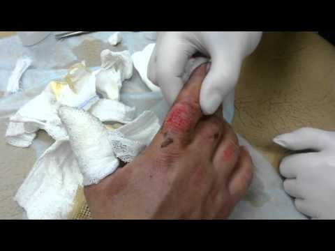 Видео: Лечение ожогов кистей (перевязка)