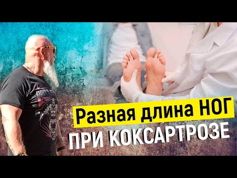 Видео: РАЗНАЯ ДЛИНА НОГ при коксартрозе - ЧТО ДЕЛАТЬ? | ТРЕНЕР ХАПАЕВ
