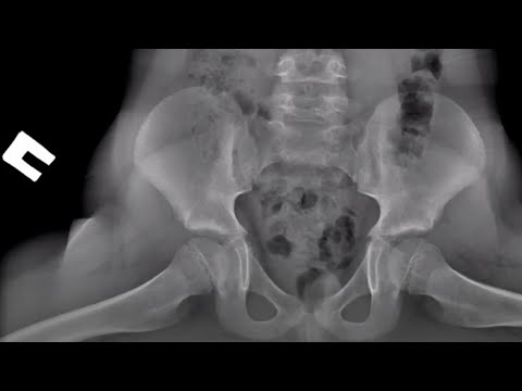 Видео: Укладка тазобедренного сустава (Новое)