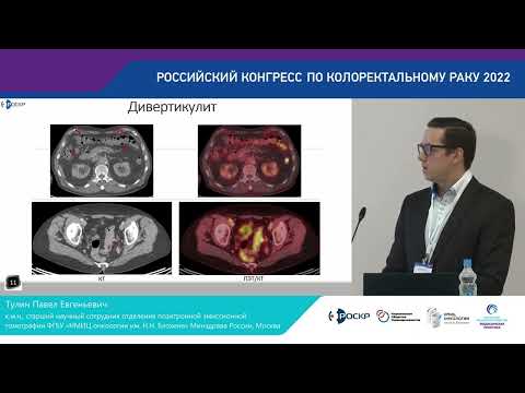 Видео: ПЭТ/КТ с 18F-ФДГ. ДОБРОКАЧЕСТВЕННЫЕ ИЗМЕНЕНИЯ  ТОЛСТОЙ КИШКИ