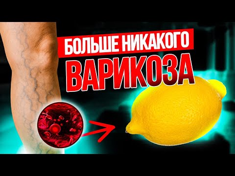 Видео: Лимон убирает варикоз! Просто делайте это каждый день...