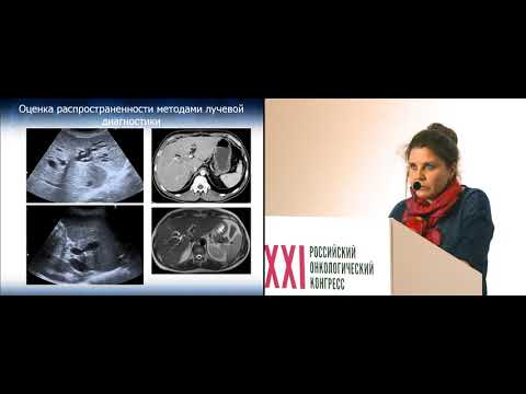 Видео: Принципы оценки распространенности поражения желчных протоков при опухолях Клатскина